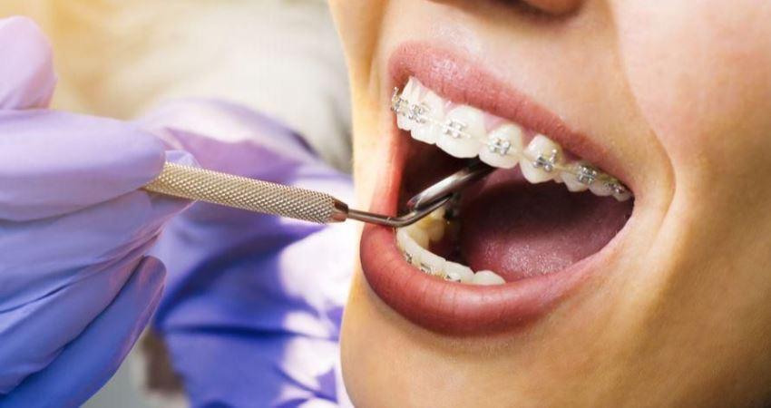 Cara Mudah Merawat Gigi yang Memakai Behel