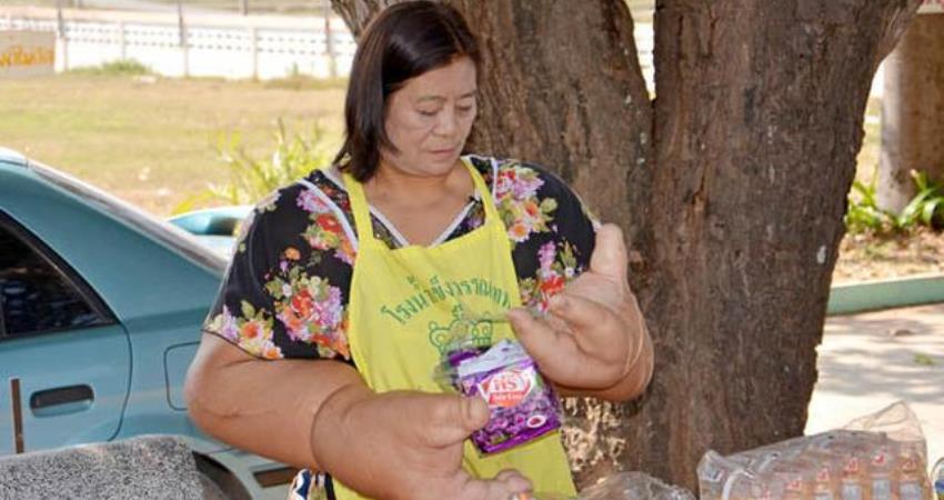 Duangjay Samaksamam Punya Tangan Raksasa Akibat Penyakit Langka